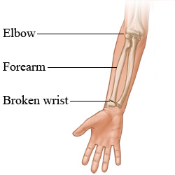 fractures-around-wrist
